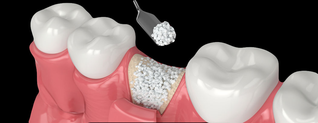 bone grafting