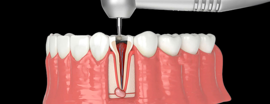 root canal