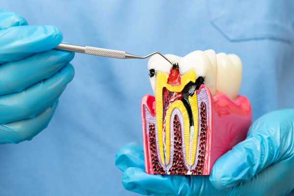 Symptoms That Indicate You May Need A Root Canal